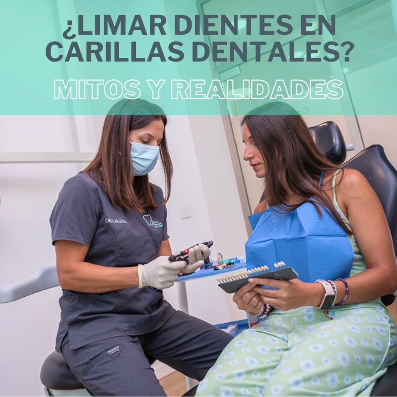 porque limar dientes carillas dentales